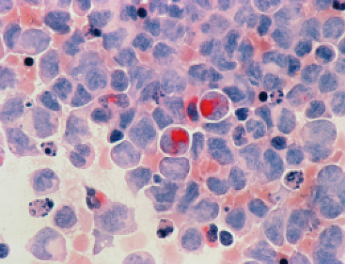 Tumorile pancreatice